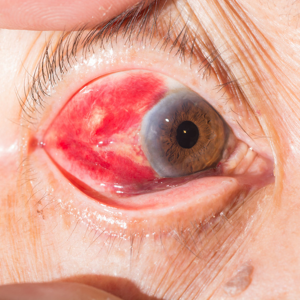 視力検査で結膜 heamorrhage - 写真・画像