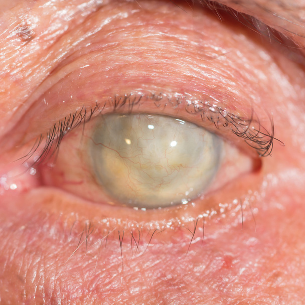 phthisis bulbi at eye test - Photo, Image