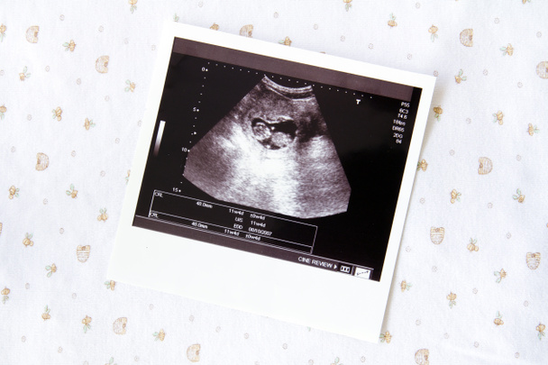 Imagem de ultrassom para gravidez
 - Foto, Imagem