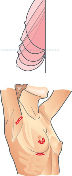 Plastická chirurgie prsou - Vektor, obrázek