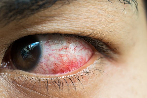 irritado vermelho olho de sangue, Close Up
  - Foto, Imagem