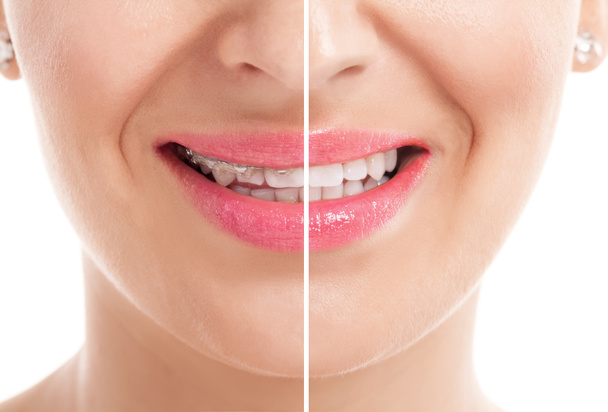 Зубы с брекетами
 - Фото, изображение