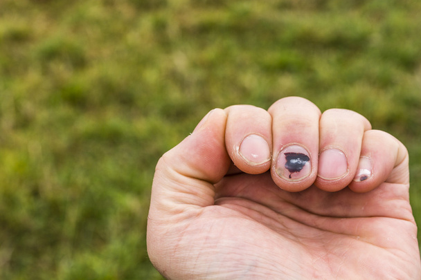 Підвузлова гематома на пальцях ніг
 - Фото, зображення