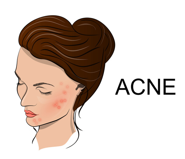 ilustración del acné
 - Vector, Imagen