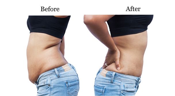 women body fat belly between before and after weight loss - Photo, Image
