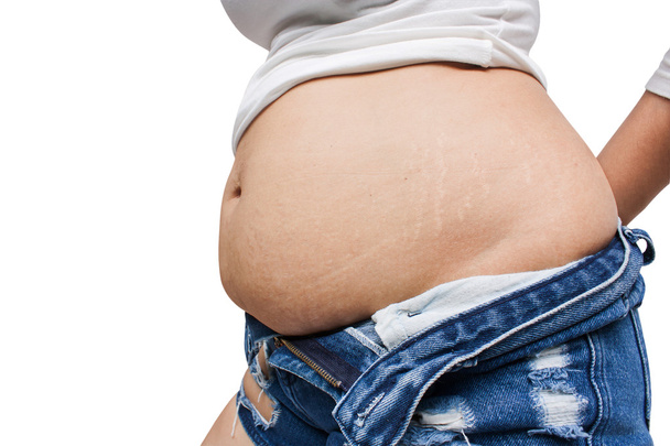 Women body fat belly and scratch mark - Fotografie, Obrázek