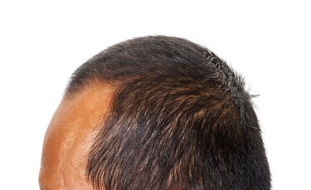 Απώλεια μαλλιών, ανδρική κεφάλι με τριχόπτωση, απομονώνονται σε λευκό backgro - Φωτογραφία, εικόνα