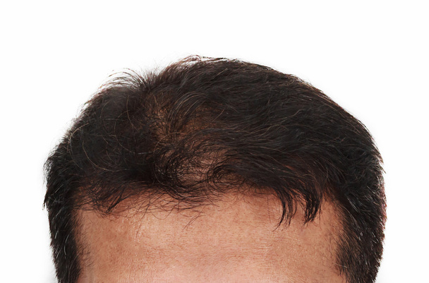 τριχόπτωση, αρσενική κεφάλι με συμπτώματα απώλειας μαλλιών εμπρός όψη - Φωτογραφία, εικόνα