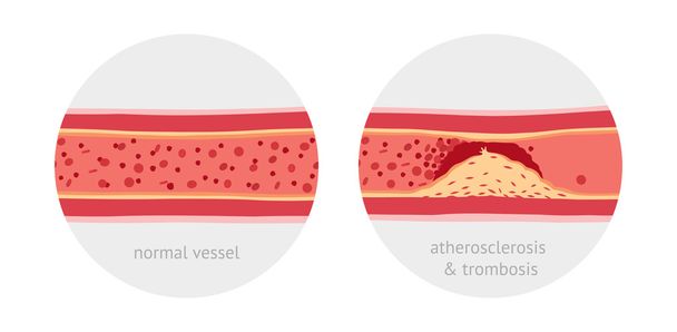 Aterosclerosis en los vasos
 - Vector, imagen