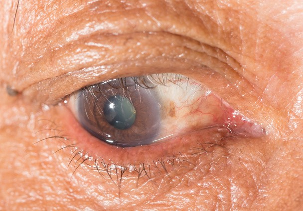 trachoma  at eye test - Photo, Image