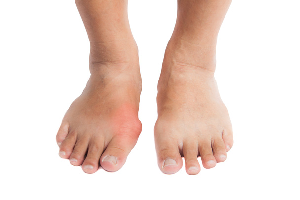Пара ног с деформированным правым пальцем из-за болезненного воспаления подагры
. - Фото, изображение