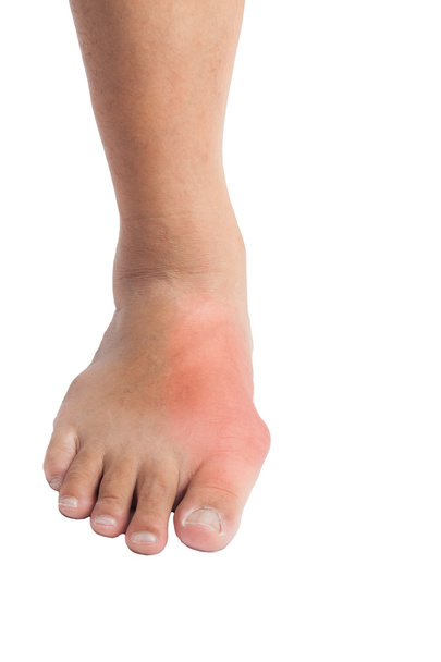 痛みを伴う痛風の炎症による変形足の親指 - 写真・画像