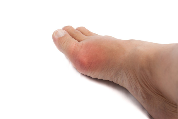 Деформированный большой палец ноги из-за болезненного воспаления подагры
 - Фото, изображение