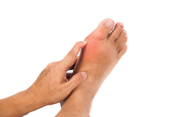 Inflammation douloureuse de la goutte sur les gros orteils
 - Photo, image