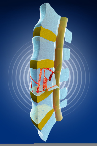 Espina dorsal, médula, fracturas traumáticas vertebrales
 - Foto, Imagen