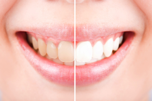 Θηλυκό μεταξύ πριν και μετά την κινηματογράφηση σε πρώτο πλάνο δόντια βούρτσα τα δόντια,  - Φωτογραφία, εικόνα