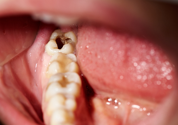 Поврежденный зуб с кариесом кариеса кариеса полости
 - Фото, изображение