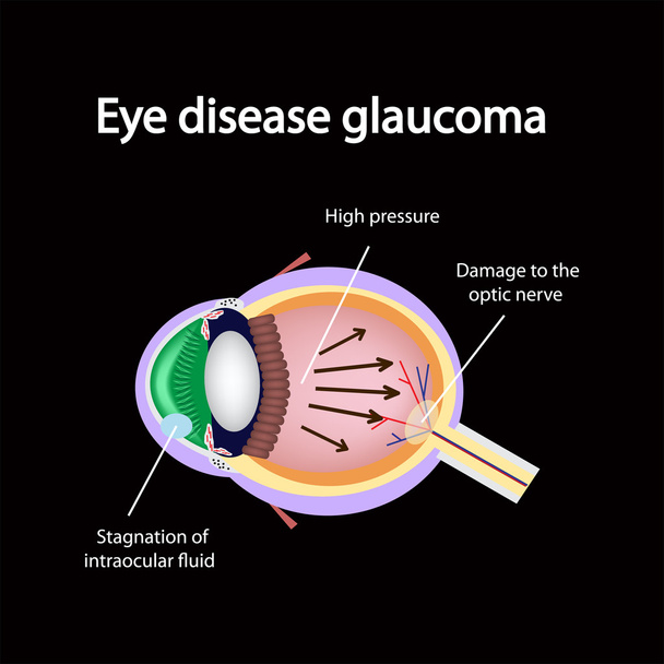 Glaukooma silmä. Glaukoomaa aiheuttavat rikkomukset
 - Vektori, kuva