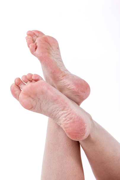 dry dehydrated skin on the heels of female feet with calluses - Photo, Image