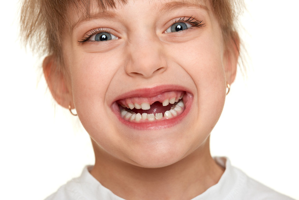 失われた歯の女の子の顔のクローズ アップ - 写真・画像