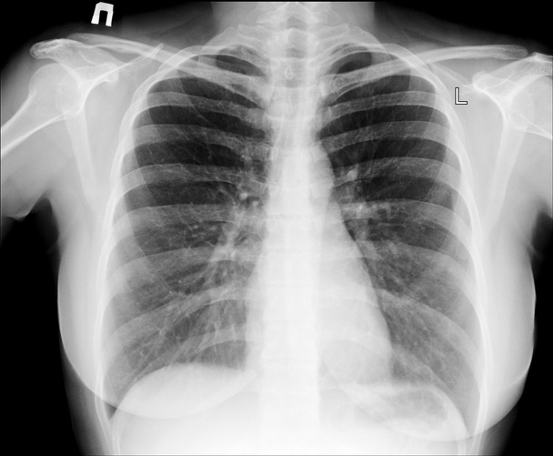 Röntgenkuva rinnassa
 - Valokuva, kuva