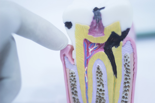 Модель зубного зуба, що показує коріння емалі розпаду
 - Фото, зображення