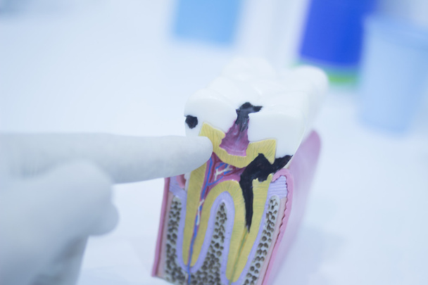 dentystyczny ząb modelu obsada Wyświetlono próchnica szkliwa korzenie - Zdjęcie, obraz
