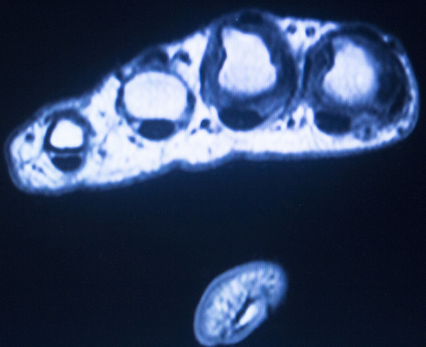 Palce dłoni rezonansu magnetycznego MRI skanowania  - Zdjęcie, obraz