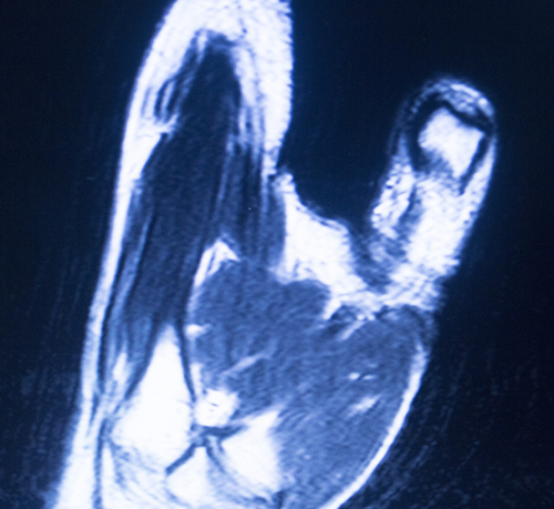 MRI magnetic resonance imaging hand carpaal-scan  - Foto, afbeelding
