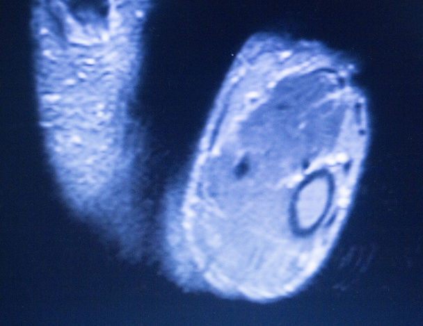Resonancia magnética por resonancia magnética escaneo de dedos de mano
  - Foto, imagen