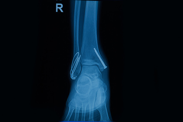 Kolekcja człowieka rentgenowskie wyświetlone złamania prawej nogi (frac - Zdjęcie, obraz