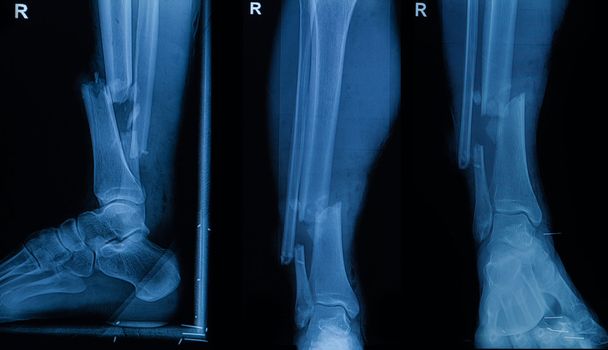 Colección de radiografías humanas que muestran fractura de pierna derecha (frac
 - Foto, imagen