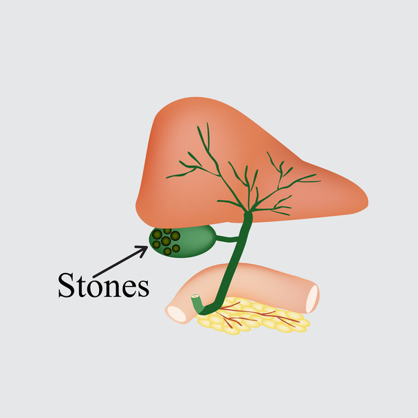 Le pietre nella cistifellea. Duodeno, pancreas, dotti biliari. Illustrazione vettoriale su sfondo grigio
 - Vettoriali, immagini