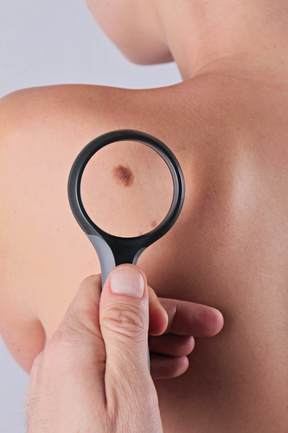 Close up of doctor dermatologist examines a birthmark of patient. Checking benign moles - Foto, Imagem