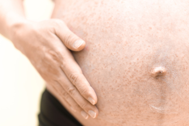 Alergia en el vientre embarazada
 - Foto, Imagen