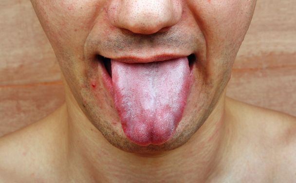 Disease tongue infection - Foto, afbeelding
