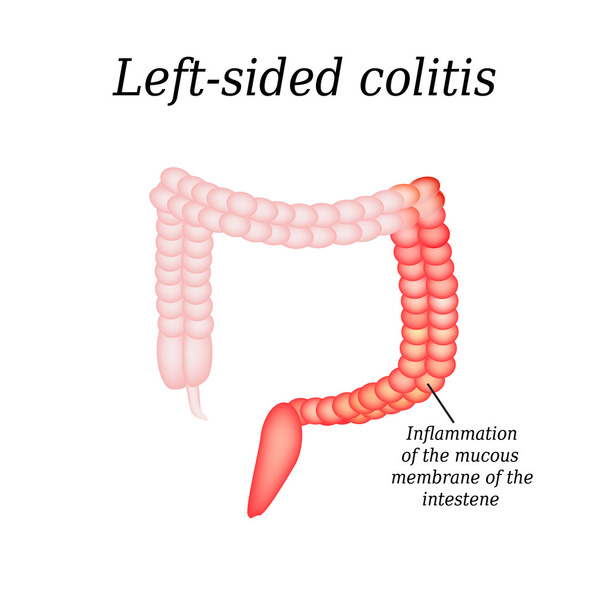 Inflammation of the large intestine divisions. Vector illustration on isolated background - Vector, Image