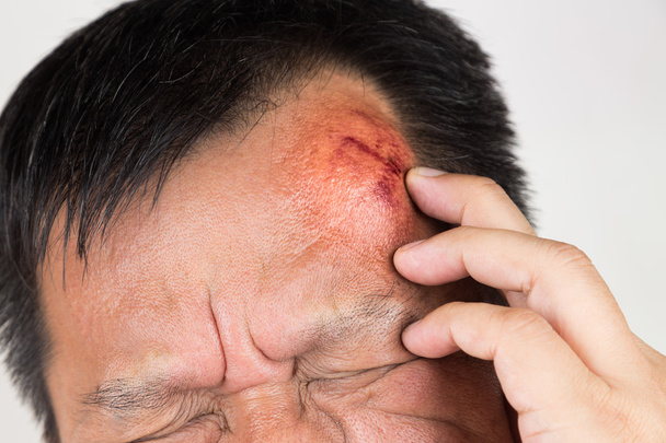Foco seletivo em lesão dolorosa na testa inchada vermelha
 - Foto, Imagem