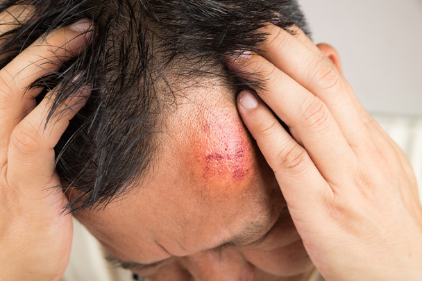 Enfoque selectivo en lesiones en la frente inflamadas rojas dolorosas
 - Foto, Imagen