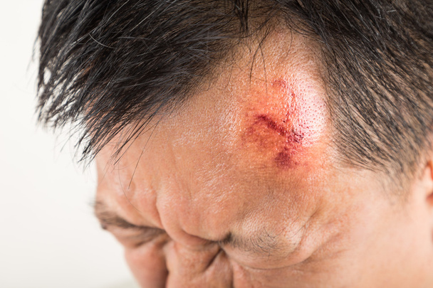 Concentrazione selettiva su lesioni dolorose alla fronte gonfie rosse
 - Foto, immagini