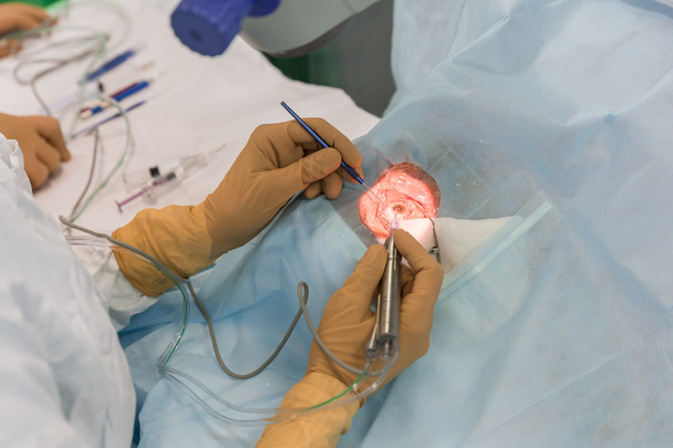 Bimanual cataract extraction - Fotoğraf, Görsel
