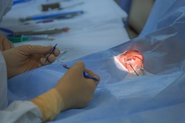 Bimanual cataract extraction - 写真・画像
