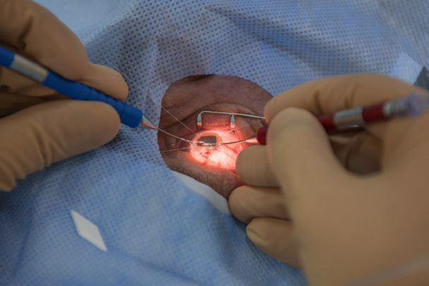 Using Iris retractors during ophtalmology operation. - Φωτογραφία, εικόνα