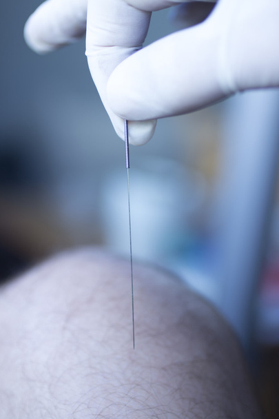 Acupunctuur naalden dry needling - Foto, afbeelding