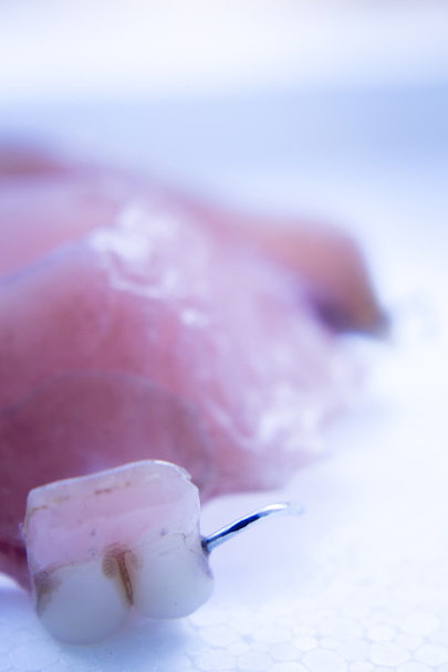 Proteettinen hammas osittainen tekohampaat
 - Valokuva, kuva