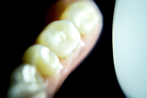 Protez diş Kısmi Protez - Fotoğraf, Görsel