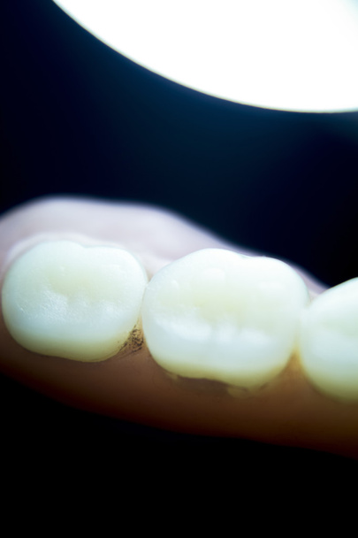 Prótesis dentales parciales dentales
 - Foto, Imagen
