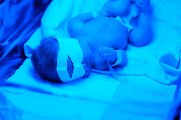 neonato sotto la luce UV blu
 - Foto, immagini