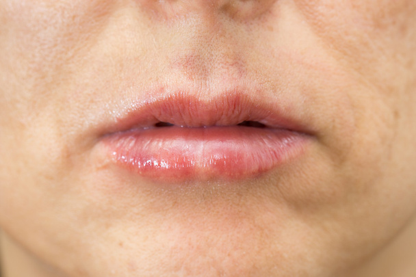 Primo piano della donna gonfiore delle labbra dopo il trattamento
 - Foto, immagini