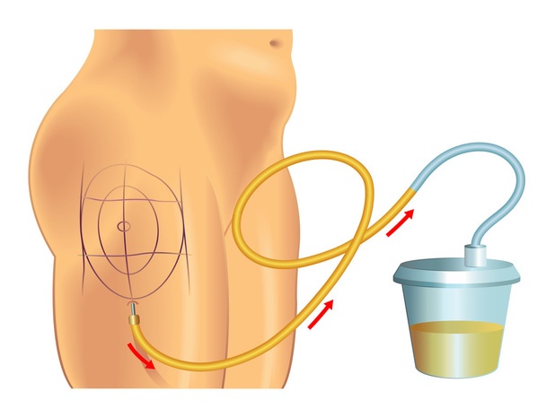 mechanism of human liposuction - Vector, Image